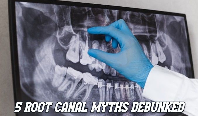 5 Root Canal Myths Debunked