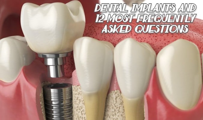 Dental Implants and 12 Most Frequently Asked Questions