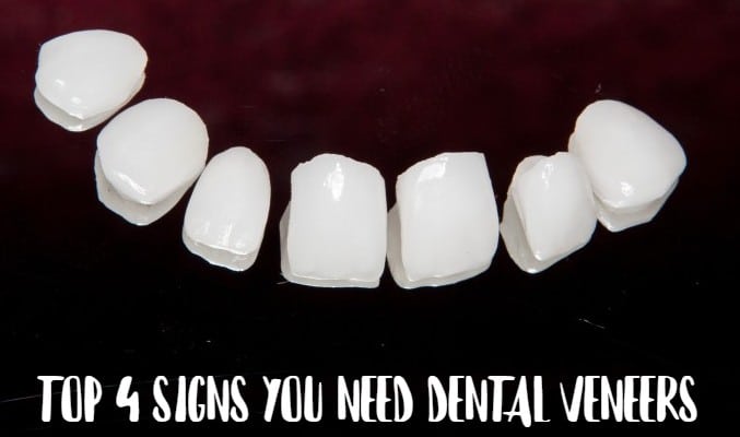 Top 4 Signs You Need Dental Veneers