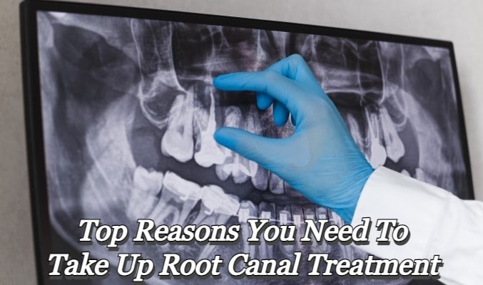 Top Reasons You Need To Take Up Root Canal Treatment